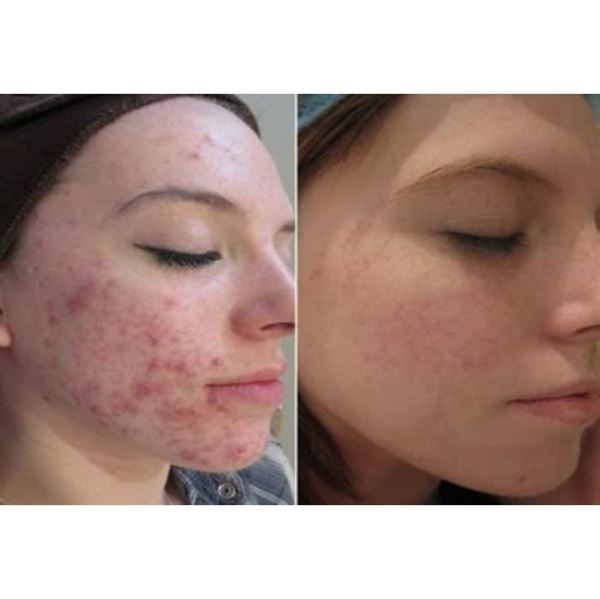 Dermaroller 540 needles with Titanium needles 0.3 mm for the face - | Fashiongirl