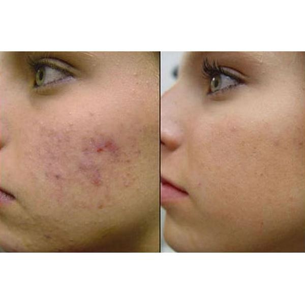 Dermaroller 540 needles with Titanium needles 0.5mm for the face - | Fashiongirl