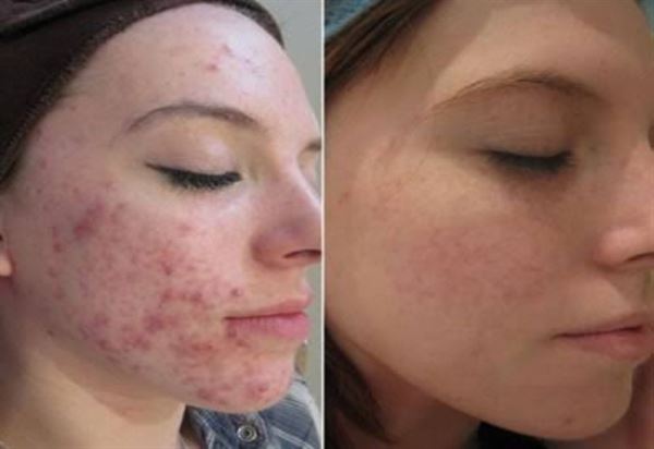 UNIQ Titanium Dermaroller 540 needles 0.25 mm. for the face - | Fashiongirl